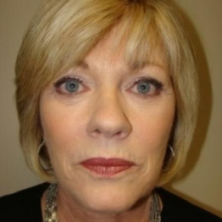 After image 1 Case #79061 - Upper and lower Eyelid Surgery