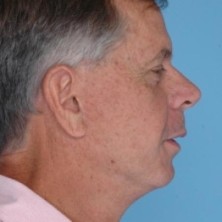 After image 3 Case #79686 - Facelift