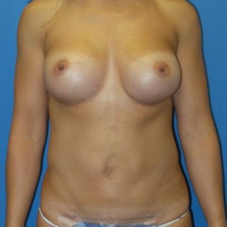 After image 1 Case #86441 - Submuscular Breast Augmentation 420cc Shaped Moderate Projection Silicone Gel Implants