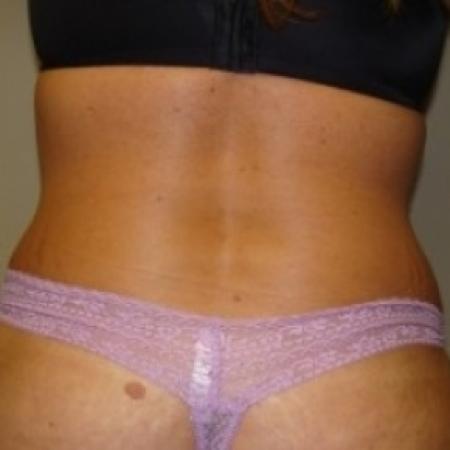 After image 4 Case #79471 - Tummy Tuck
