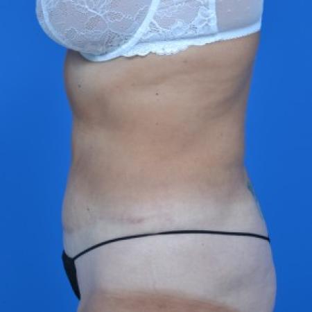 After image 3 Case #87876 - Tummy Tuck