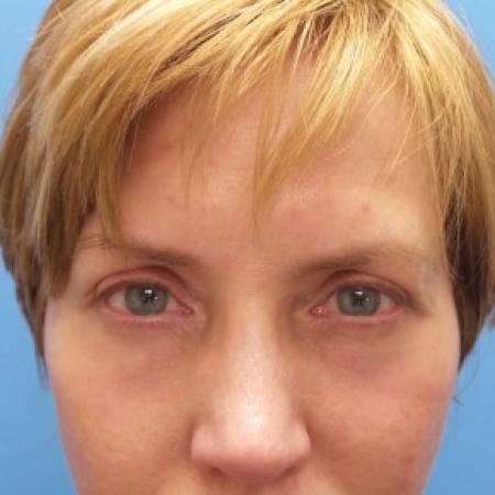 After image 1 Case #87406 - 54 year old  -  Upper Blepharoplasty/Lower Eyelid Fat Grafting & TCA Peel.  3 months Post-op