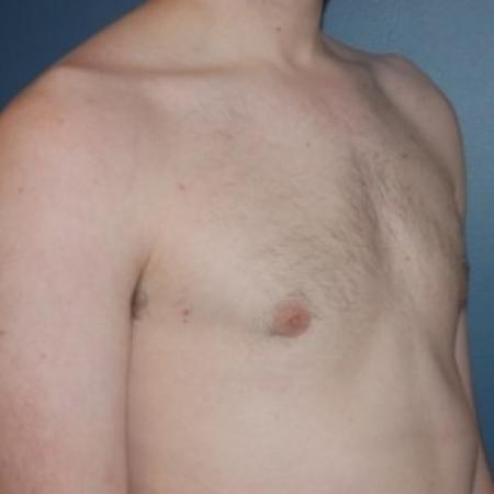 After image 3 Case #81231 - Bilateral gynecomastia