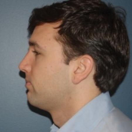 After image 3 Case #81261 - Rhinoplasty