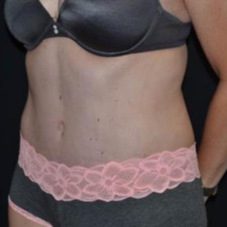After image 2 Case #83766 - Abdominoplasty - 47 year old female.