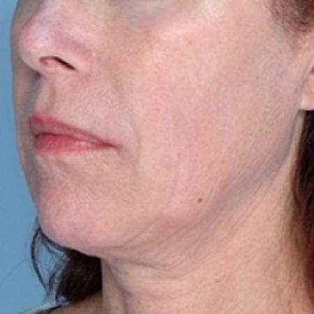 After image 1 Case #79331 - Non-Surgical Focused Ultrasound