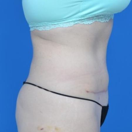 After image 2 Case #87866 - Tummy Tuck