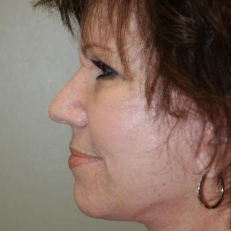 After image 3 Case #81901 - Facelift 