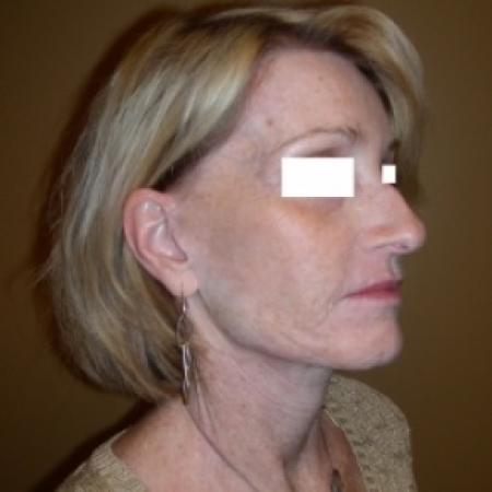 After image 2 Case #79801 - Sculptra