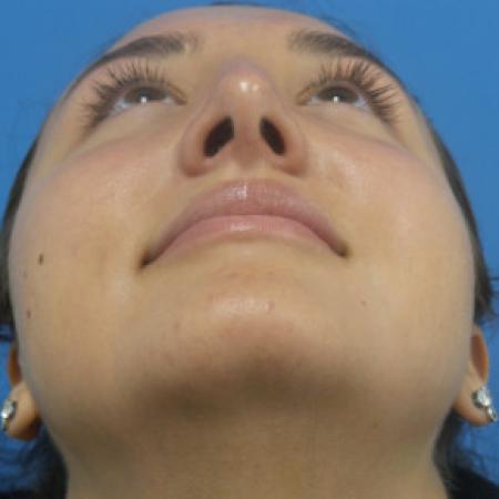 After image 4 Case #88381 - 21 year-old  -  Rhinoplasty  -  4 months post-op