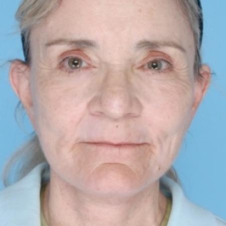 After image 1 Case #79691 - Facelift 