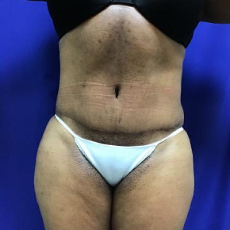 After image 1 Case #88281 - Tummy Tuck and Liposuction