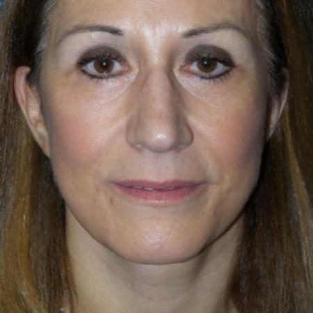 After image 1 Case #86606 - Facelift/Upper & Lower Blepharoplasty/Browlift    14 months post-op