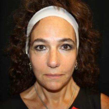 After image 1 Case #85061 - Facelift and Neck Lift - 58 year old female