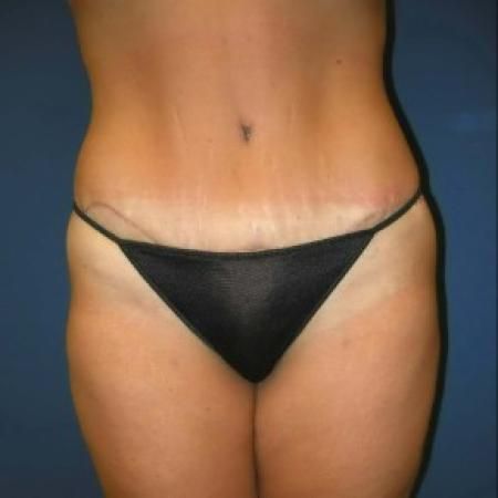 After image 1 Case #82816 - Extended Tummy Tuck and Liposuction