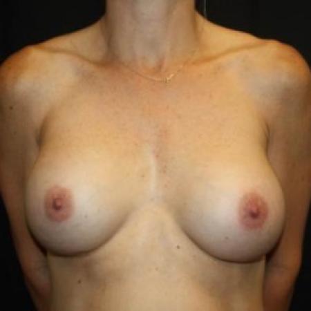 After image 1 Case #85116 - Implant Exchange - 43 year old female