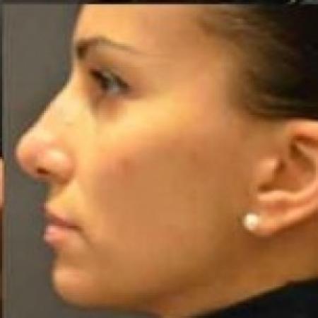 After image 3 Case #85651 - Rhinoplasty 