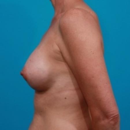 After image 3 Case #78596 - Silicone Breast Augmentation