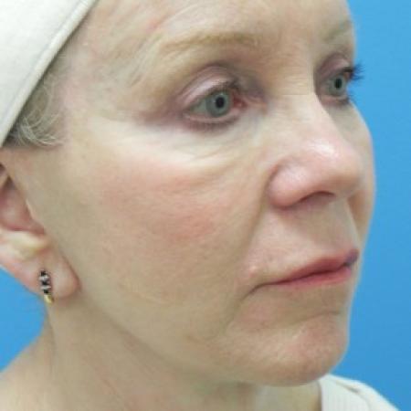 After image 2 Case #86616 - Facelift/Upper & Lower Blepharoplasty/Laser Resurfacing to Full Face/Juvederm      7 months post-op