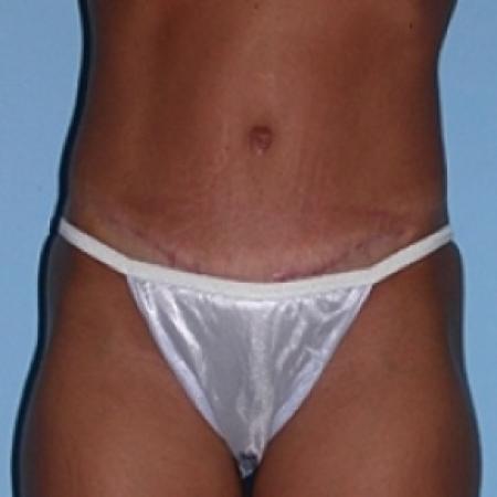 After image 1 Case #79146 - Tummy Tuck