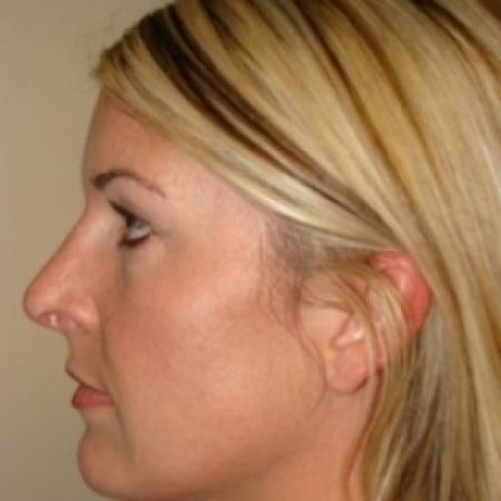 After image 3 Case #79536 - Rhinoplasty