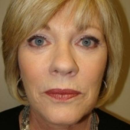 After image 1 Case #79056 - Facelift