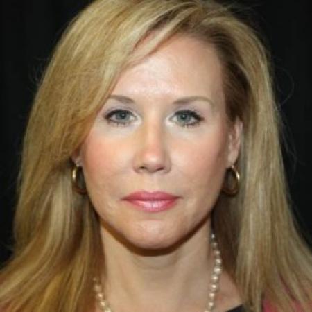 After image 1 Case #85286 - Facelift and Neck Lift - 54 year old female