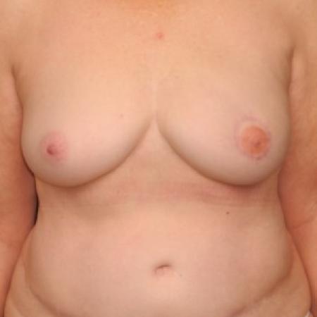 After image 1 Case #84946 - 72 y/o - Immediate Left DIEP Breast Flap Reconstruction