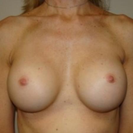 After image 1 Case #79731 - Breast Augmentation