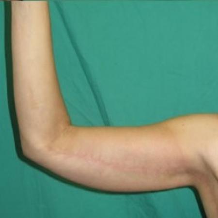 After image 1 Case #85666 - Upper Arm Lift 