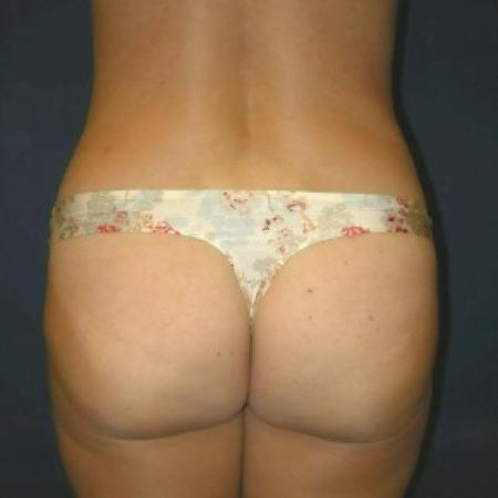 After image 3 Case #82821 - Tummy Tuck and Liposuction of Hips