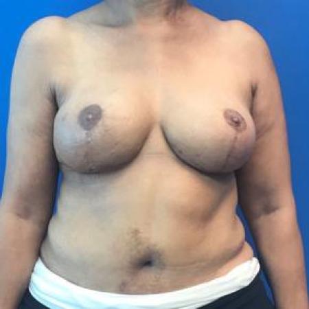 After image 1 Case #88386 - DIEP Flap Breast Reconstruction on a 66 year old female 