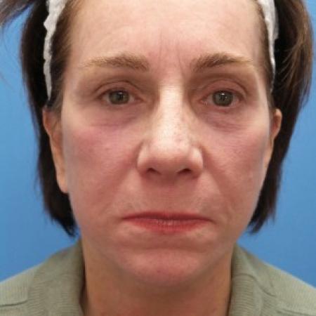 After image 1 Case #86636 - Facelift/Rhinoplasty/Laser Resurfacing to Full Face