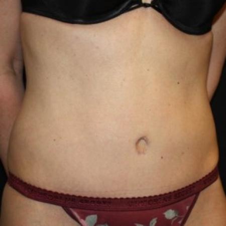 After image 2 Case #83726 - Abdominoplasty - 37 year old female.
