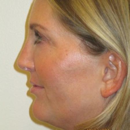 After image 2 Case #82716 - Fat transfer to Face (39 years old)