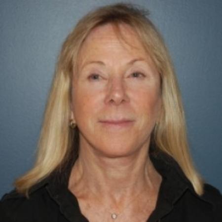 After image 1 Case #81056 - Facelift