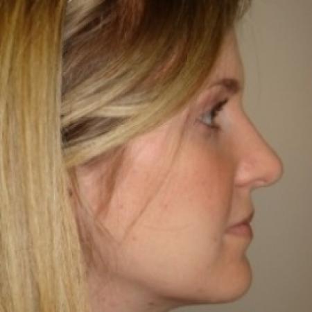 After image 4 Case #79551 - Rhinoplasty