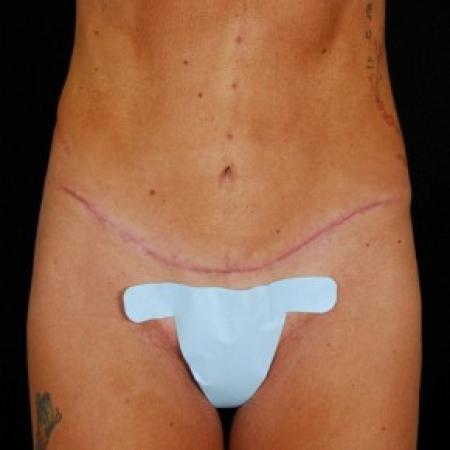 After image 1 Case #81571 - Tummy Tuck