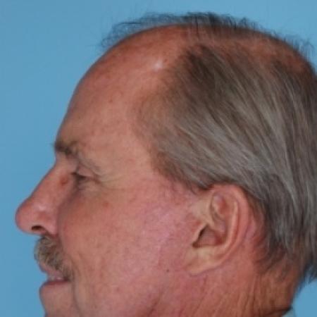 After image 3 Case #79681 - Facelift