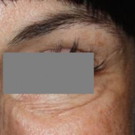 After image 2 Case #84336 - Botox Crows - 39 year old female