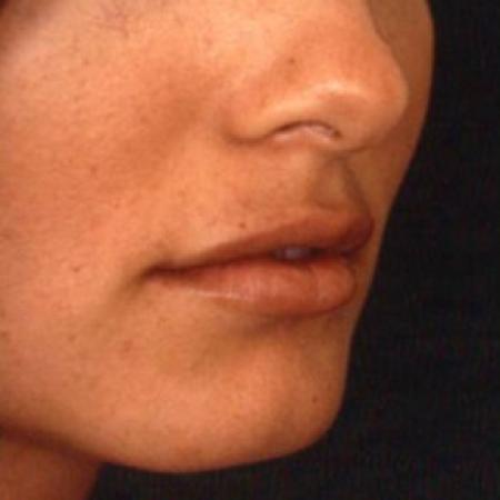 After Case #81636 - Lip Augmentation