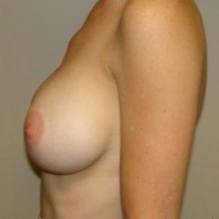 After image 3 Case #79431 - Breast Augmentation