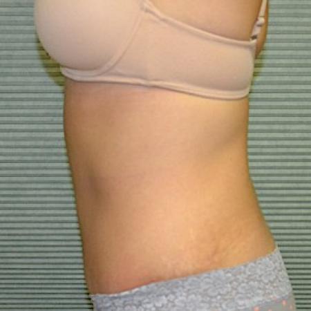 After image 2 Case #87836 - Tummy Tuck and liposuction of flanks