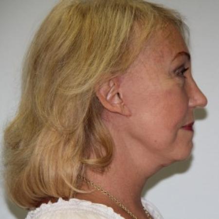 After image 3 Case #84626 - Lower facelift, necklift and browlift with SMAS grafting to Nasolabial folds