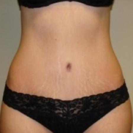 After image 1 Case #79476 - Tummy Tuck