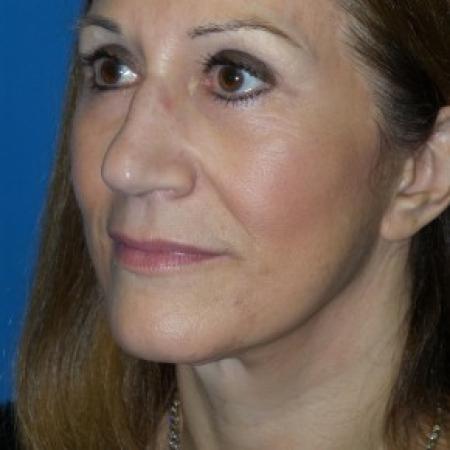 After image 2 Case #86606 - Facelift/Upper & Lower Blepharoplasty/Browlift    14 months post-op