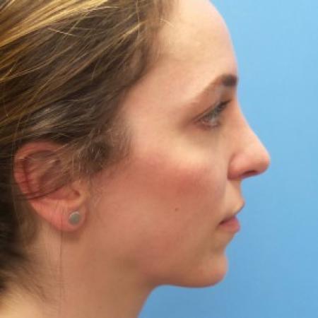 After image 3 Case #87411 - 31 year-old  -  Open Rhinoplasty/Endoscopic Browlift  -  3 months post-op