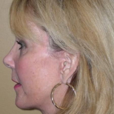 After image 1 Case #79511 - Face Lift 