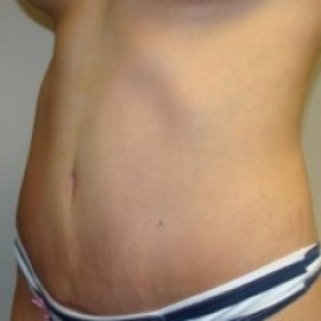 After image 2 Case #79496 - Tummy Tuck