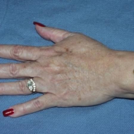 After image 1 Case #79786 - Fat Transfer Hand Rejuvenation